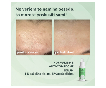 BasicLab Dermocosmetics Normalizing Anti-Comedone serum z 1 % salicilno kislino in 5 % azeloglicinom